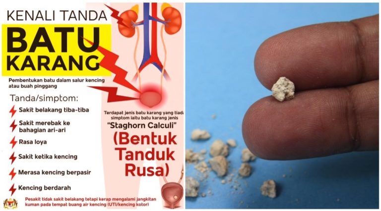 Batu Karang (Kidney Stone): &amp;#039;Sakit Menggigil, Macam Nak Bersalin