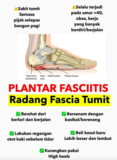Punca sakit tumit kaki bagi wanita