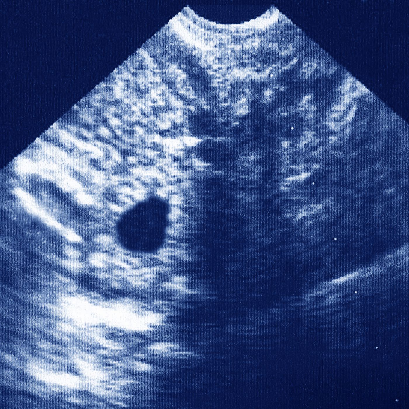 Внематочная эндометрий. Гетеротопическая беременность. Гетеротопическая беременность фото. Кальцинированный ребенок внематочной беременности. Внематочная беременность фото на человеке.