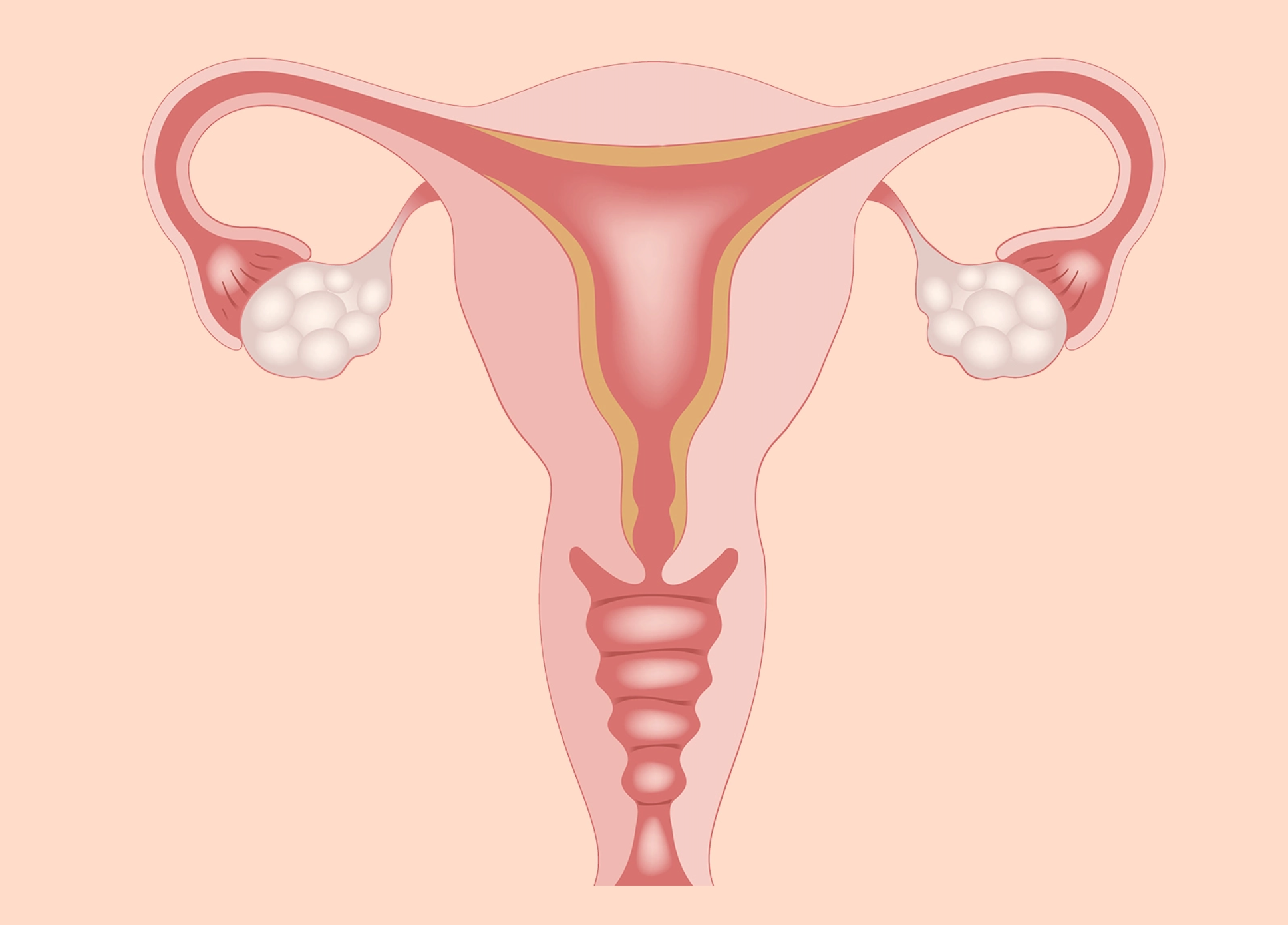 PCOS, CYST & FIBROID