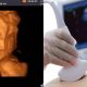scan perut ibu hamil
