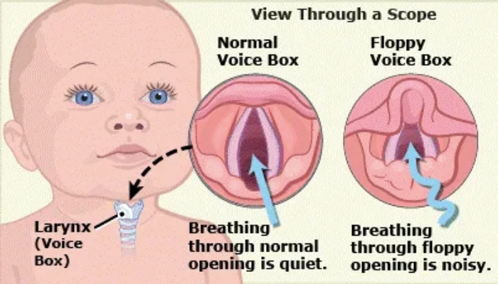 masalah nafas bayi berbunyi