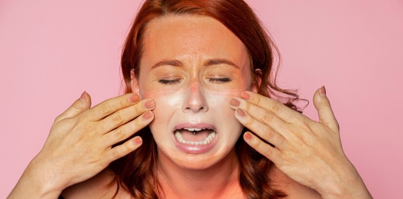 cara hilangkan sunburn muka