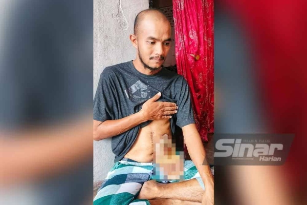 kanser usus