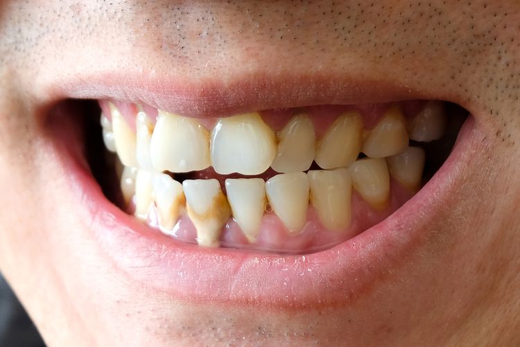 CARA HILANGKAN KARANG GIGI