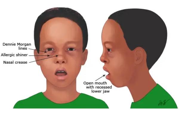 PENYAKIT ADENOID