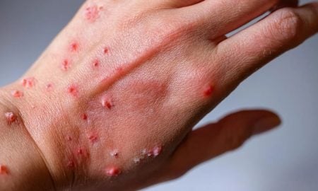 kluster mpox