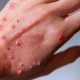 kluster mpox