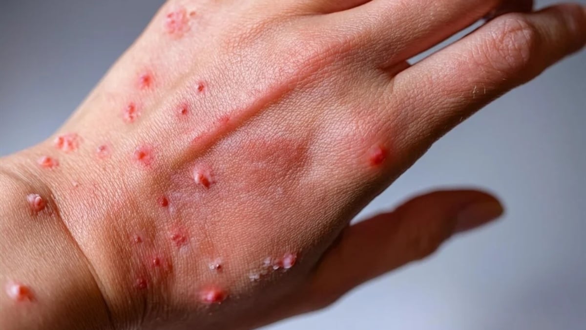 kluster mpox