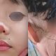 Virus Impetigo