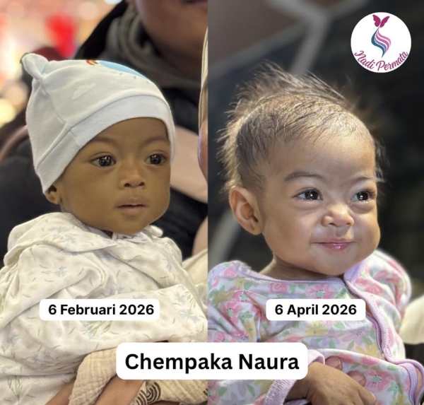 pemindahan hati Chempaka Naura