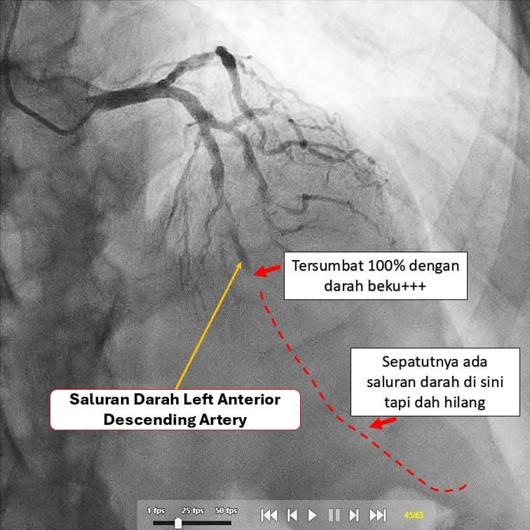 DARAH BEKU