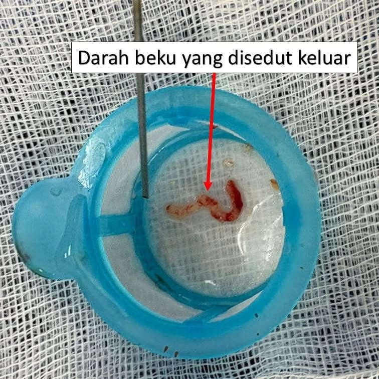 DARAH BEKU