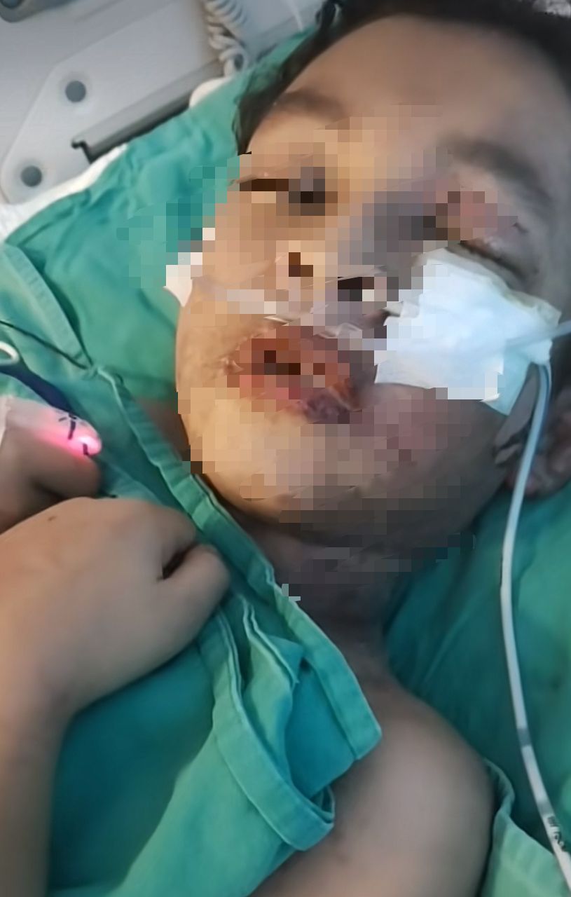 ANAK DIPATUK ULAR