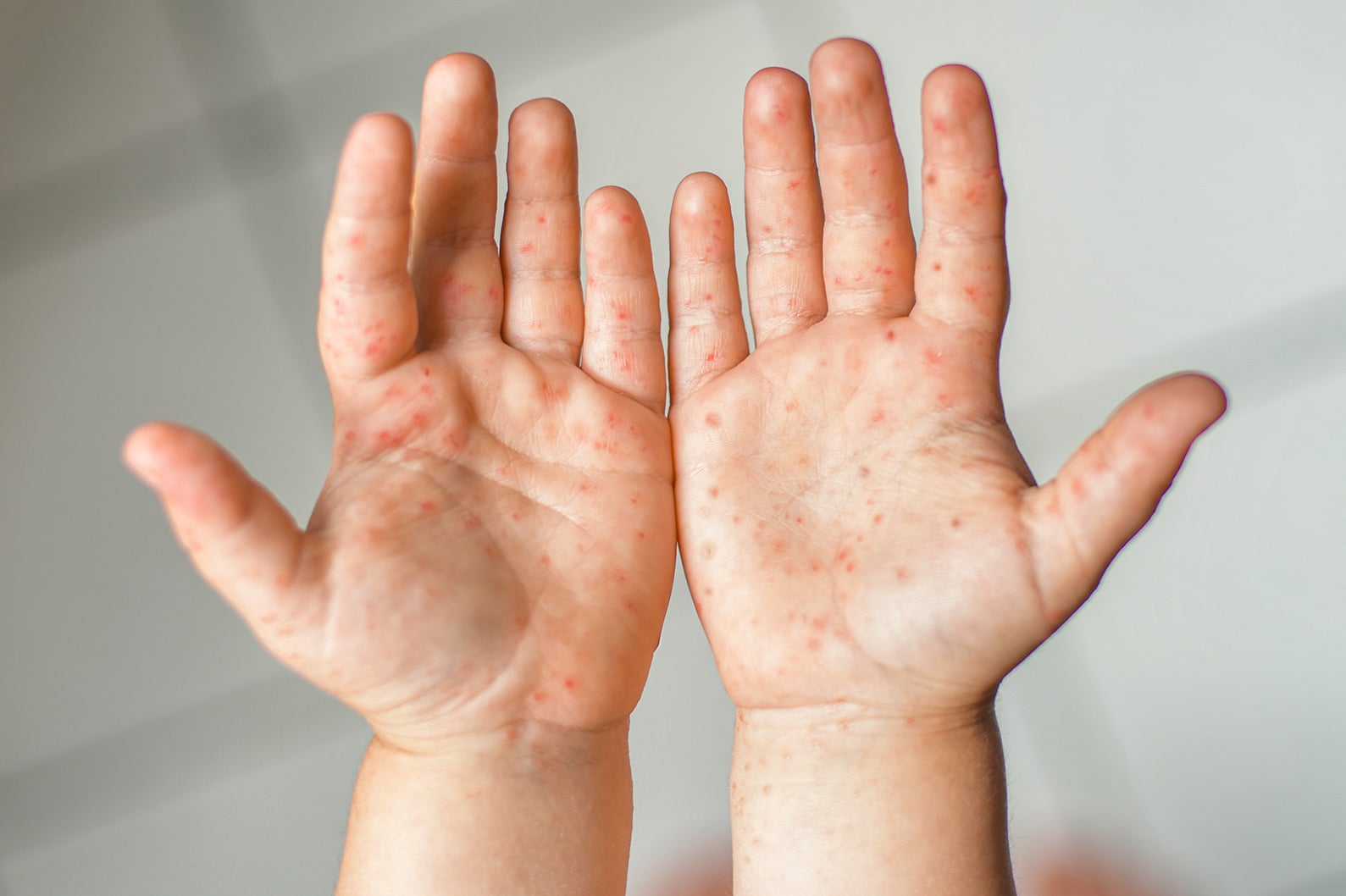 VAKSIN MEASLES RUBELLA