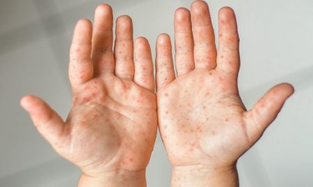 VAKSIN MEASLES RUBELLA