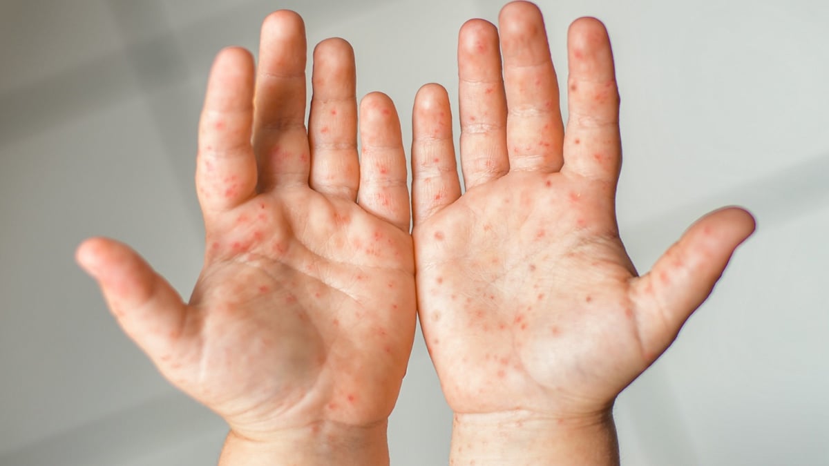 VAKSIN MEASLES RUBELLA