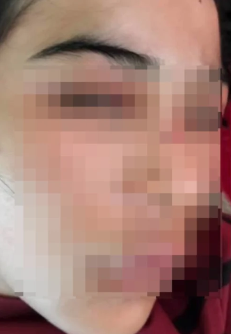PATAH HIDUNG