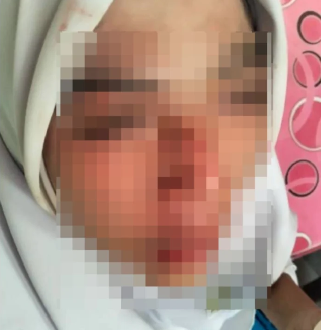 PATAH HIDUNG