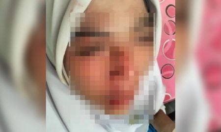 PATAH HIDUNG