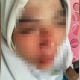 PATAH HIDUNG