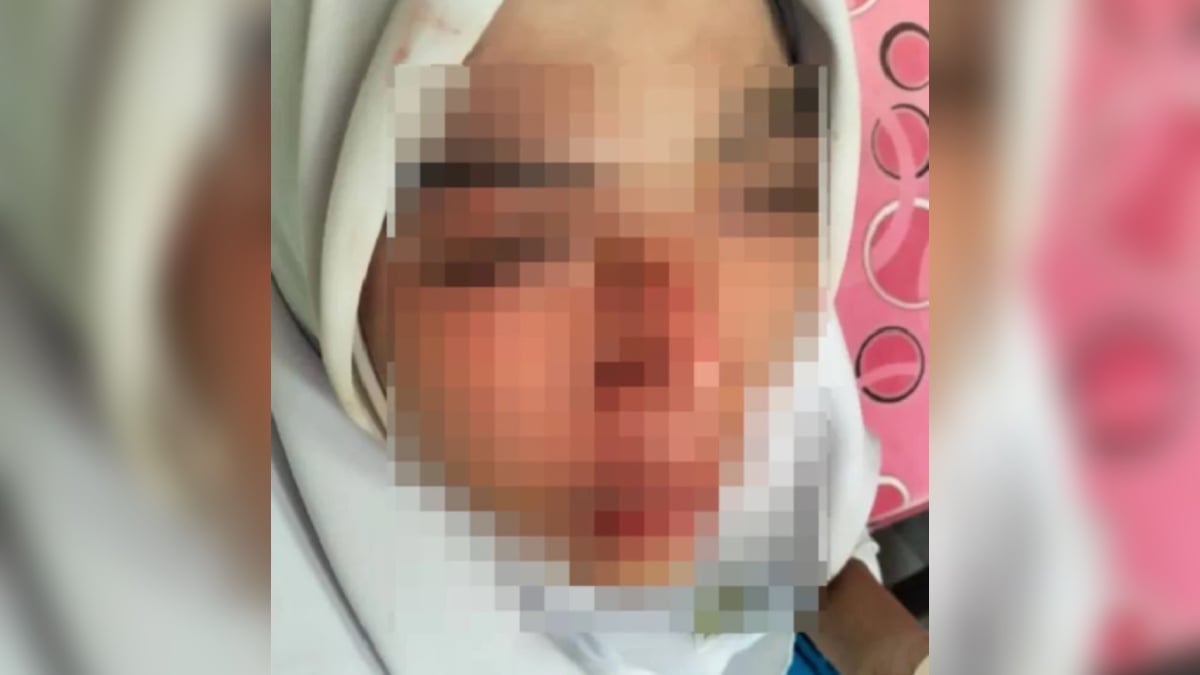 PATAH HIDUNG