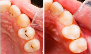 Cara menghilangkan sakit gigi