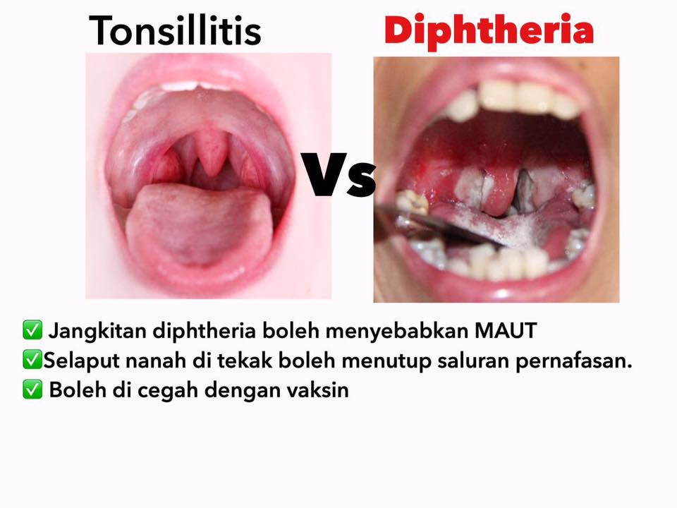 penyakit difteria
