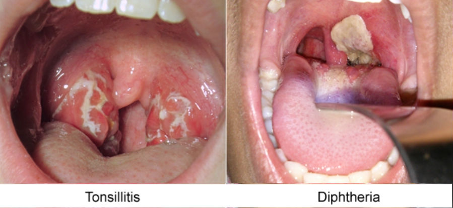 5 Cara Bezakan Penyakit Difteria Dengan Tonsil Biasa