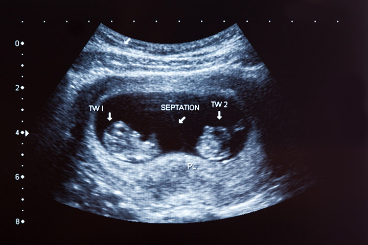 tanda kehamilan kembar