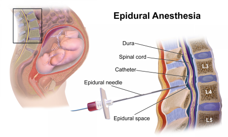 7 Perkara Tentang Epidural Semasa Bersalin, Ibu Hamil ...