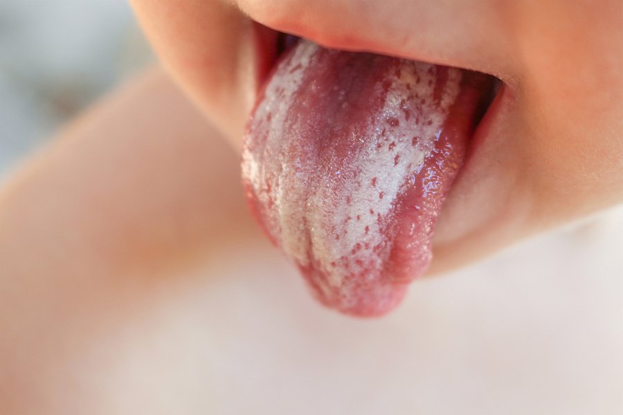 lidah bayi putih