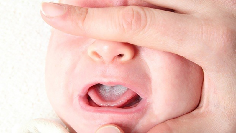 Ulser mulut bayi