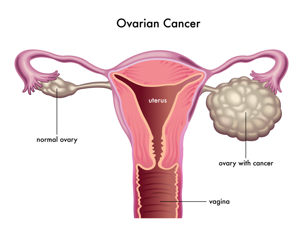 tanda kanser ovari