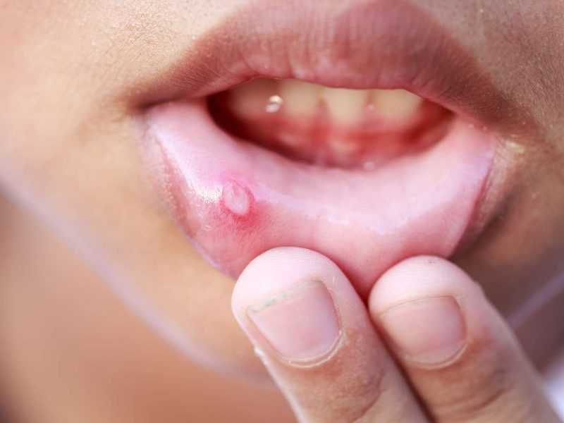 8 Cara Menghilangkan Ulser Mulut Dengan Cepat Dan Berkesan