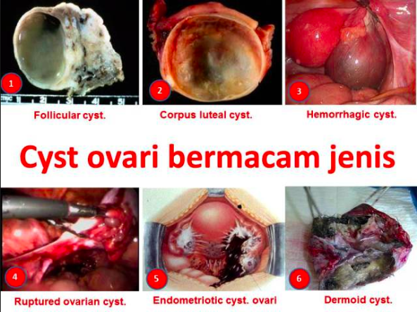 ovari cyst