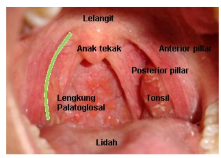 Tonsil cara merawat Cara Nak